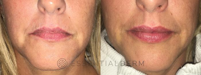 Before & After Dermal Fillers Case 46 Front View in Natick, Weston, Wayland, Framingham, and Wellesley, MA