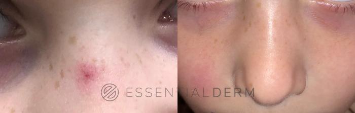 Before & After Pulsed Dye Laser Case 19 Front View in Natick, Weston, Wayland, Framingham, and Wellesley, MA