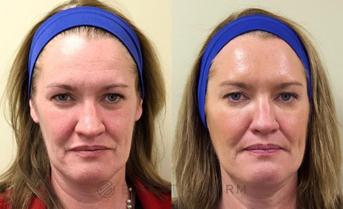 Before & After BOTOX® Cosmetic Case 2 Front View in Natick, Weston, Wayland, Framingham, and Wellesley, MA