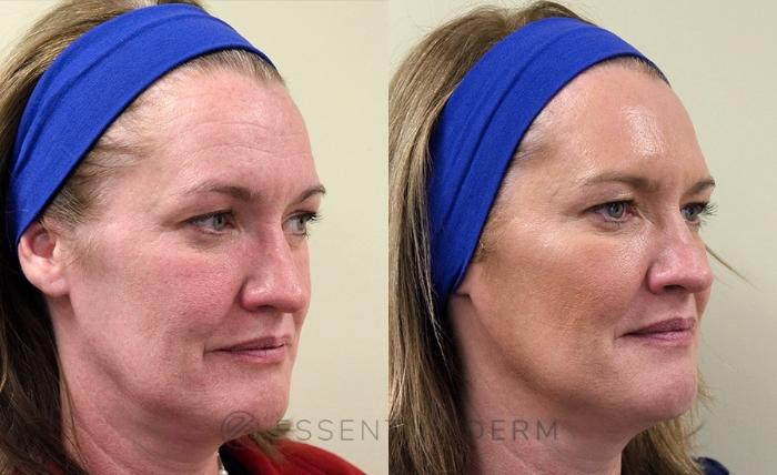 Before & After BOTOX® Cosmetic Case 2 Right Oblique View in Natick, Weston, Wayland, Framingham, and Wellesley, MA
