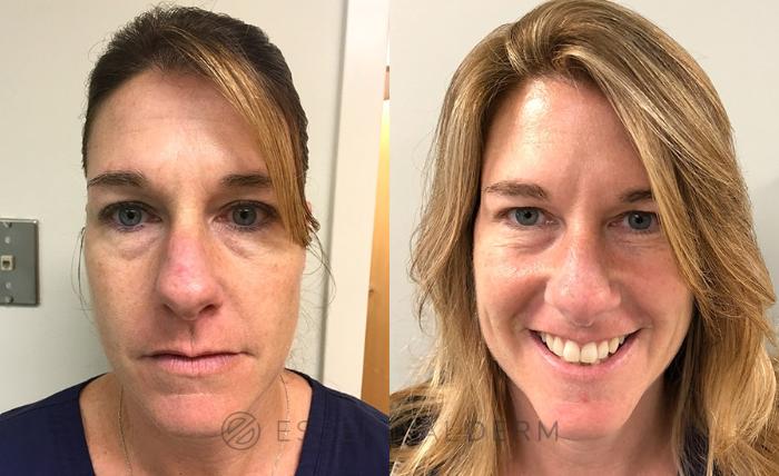 Before & After BOTOX® Cosmetic Case 7 Front View in Natick, Weston, Wayland, Framingham, and Wellesley, MA