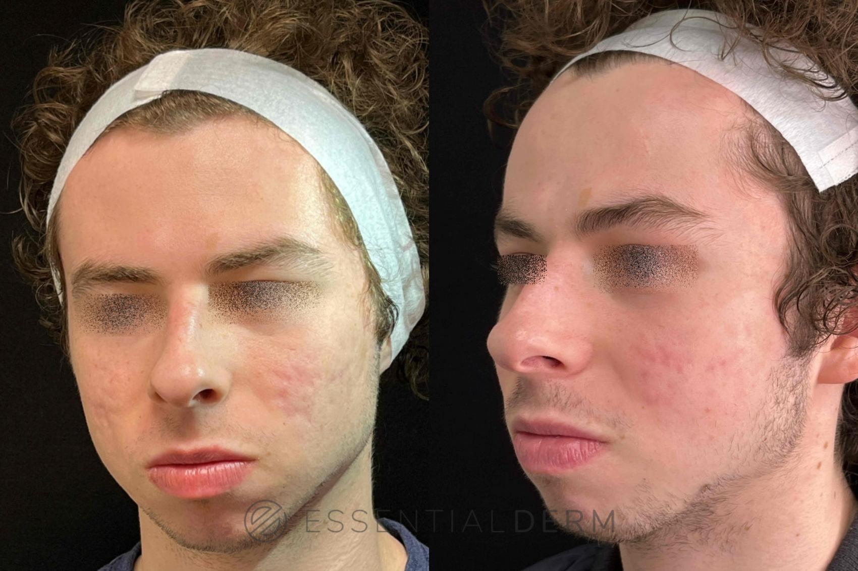 Before & After Acne Scarring Case 31 Front View in Natick, MA