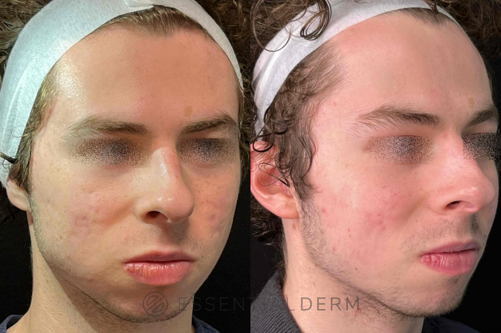 Before & After Chemical Peels Case 31 Right Side View in Natick, Weston, Wayland, Framingham, and Wellesley, MA