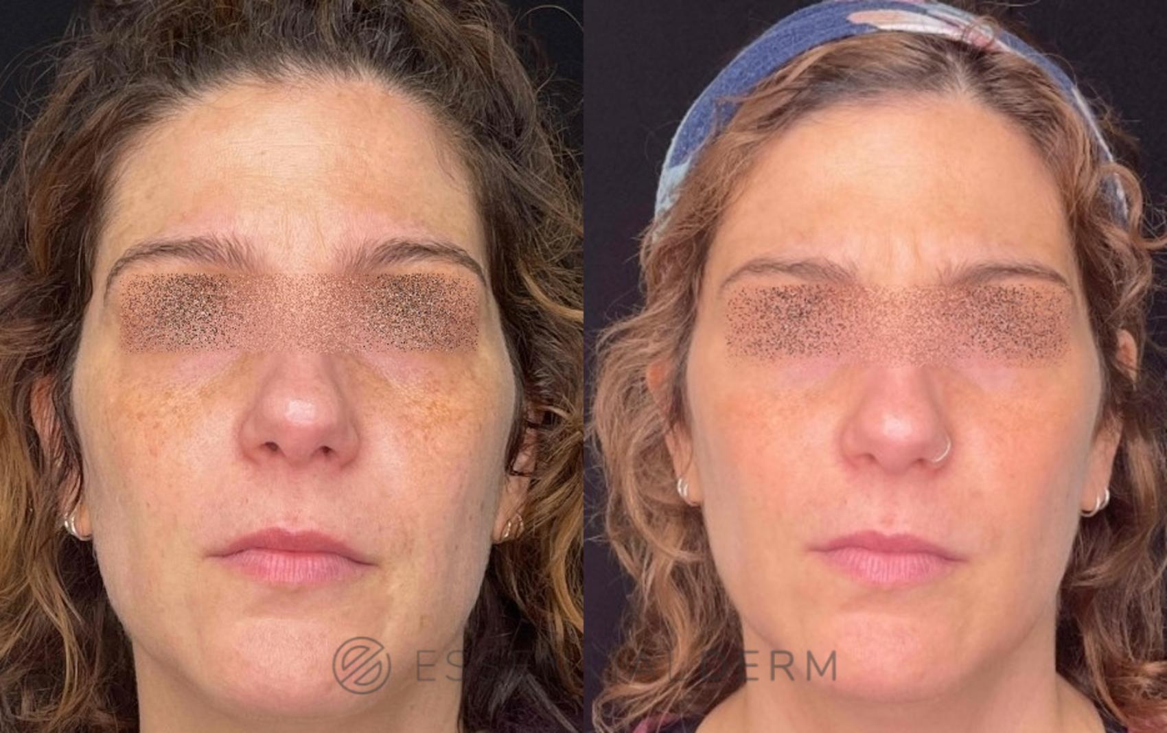 Chemical Peels in Natick for Wellesley & Weston, MA