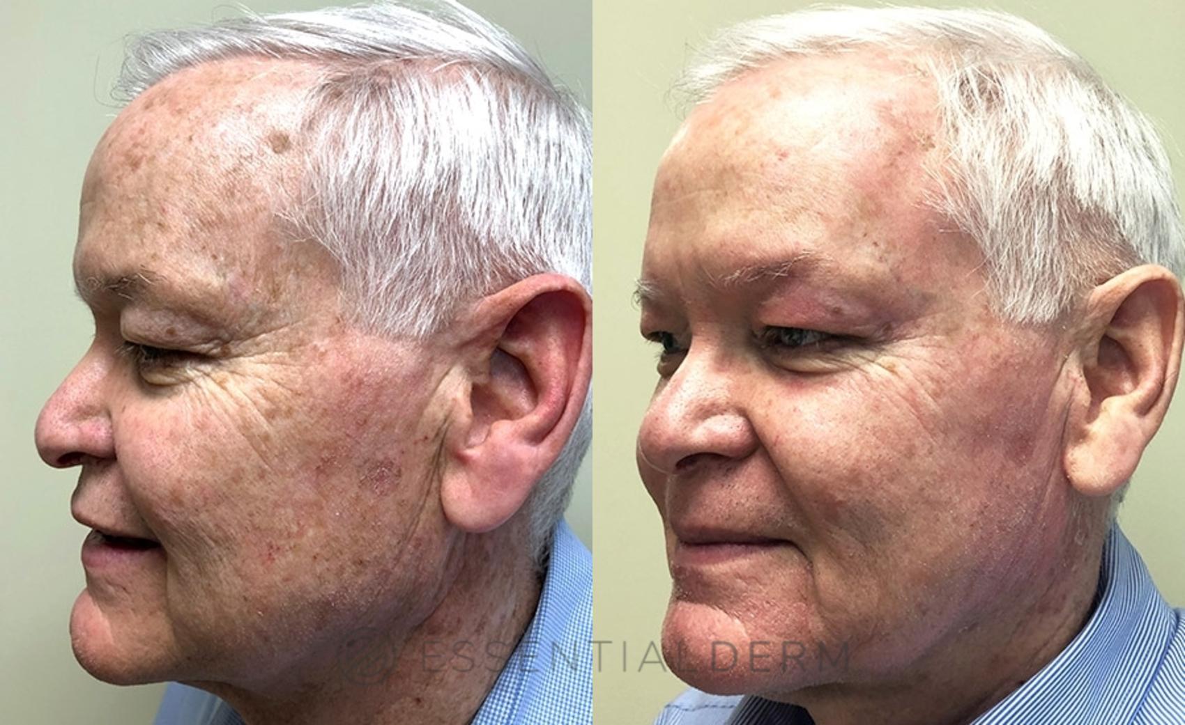 Before & After Chemical Peels Case 4 Left Side View in Natick, Weston, Wayland, Framingham, and Wellesley, MA