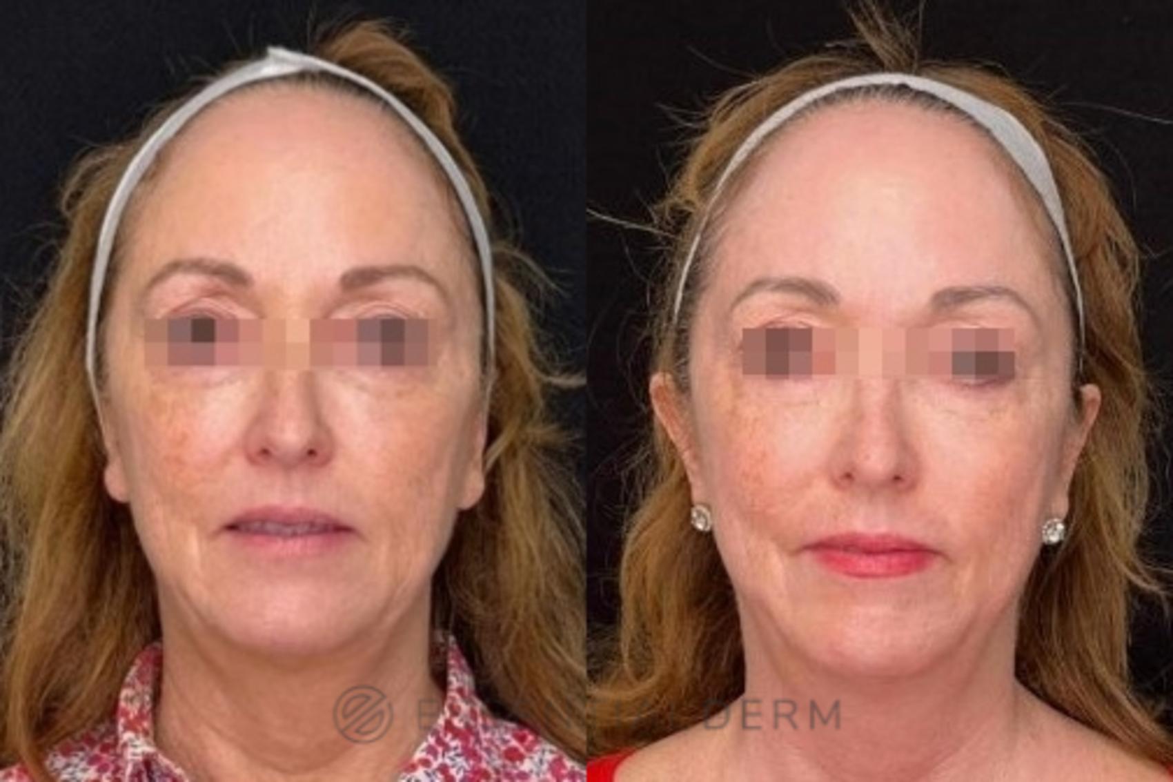 Before & After Chemical Peels Case 43 Front View in Natick, Weston, Wayland, Framingham, and Wellesley, MA