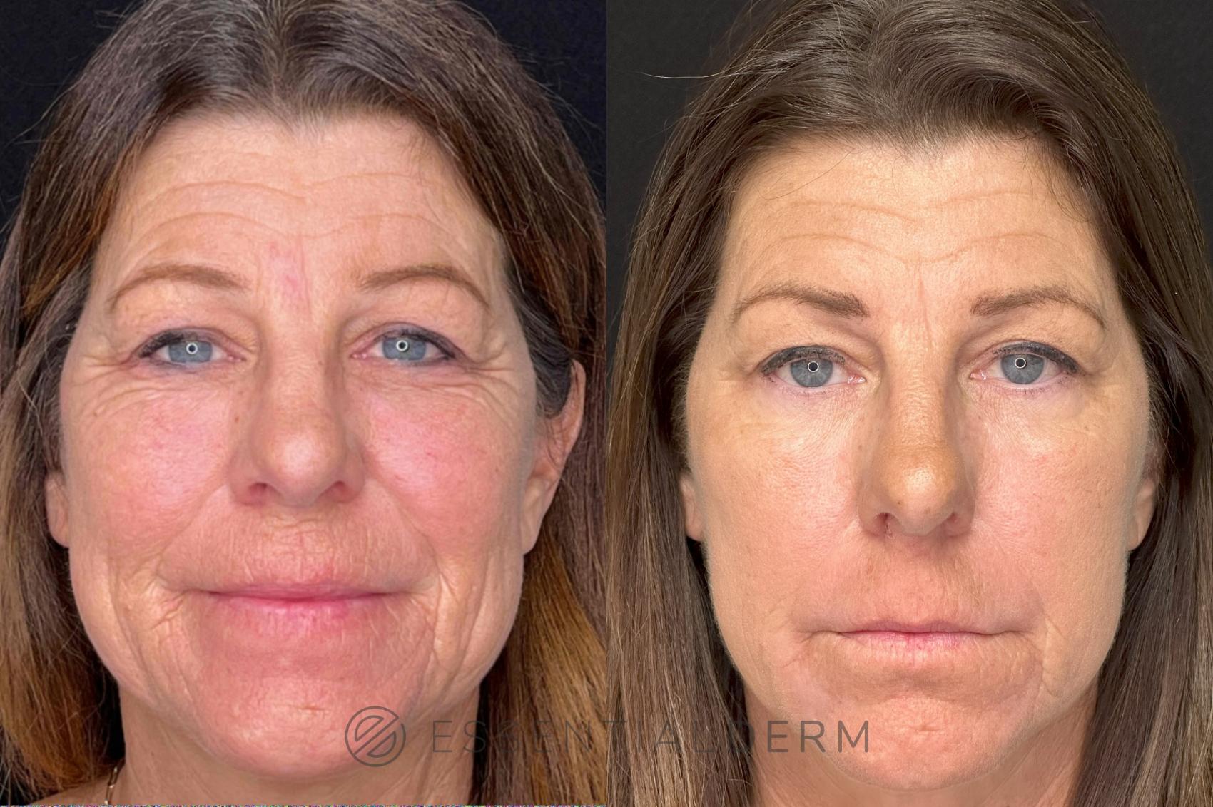 Before & After Chemical Peels Case 48 Front View in Natick, Weston, Wayland, Framingham, and Wellesley, MA