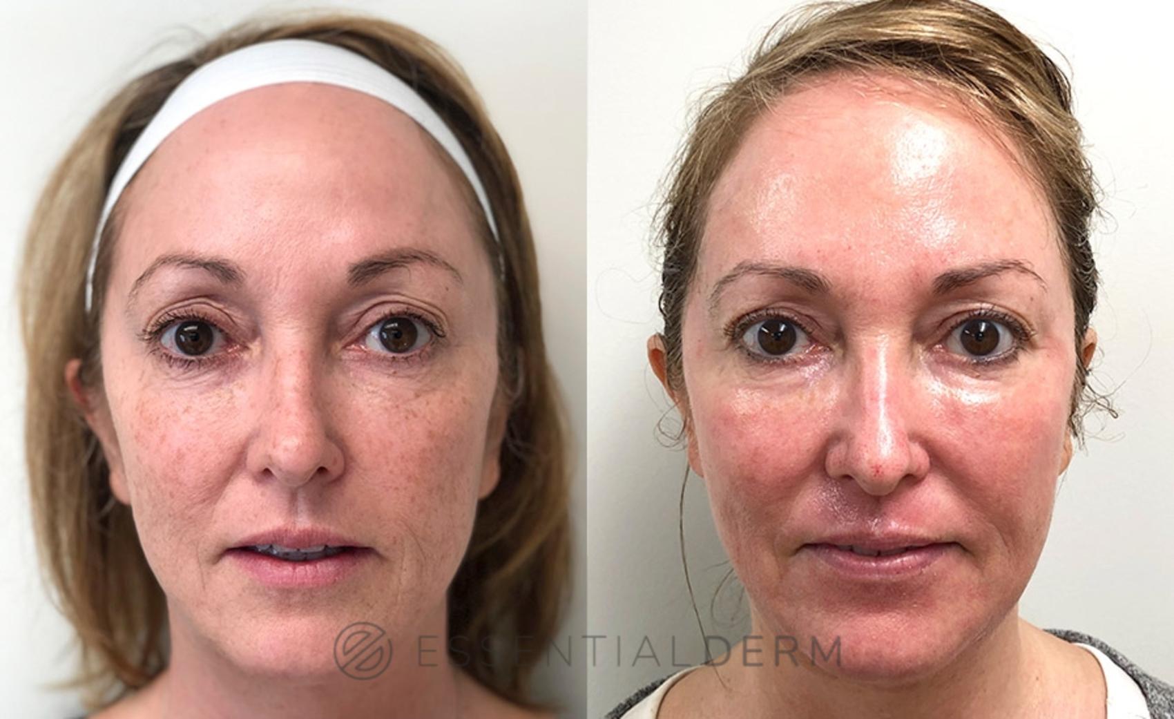 Lumenis UltraPulse® CO2 Fractional Laser Skin Resurfacing Natick, Wellesley  & Weston, MA