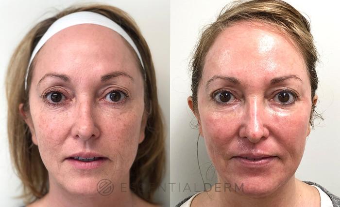 Before & After CO2 Laser Case 3 Front View in Natick, Weston, Wayland, Framingham, and Wellesley, MA
