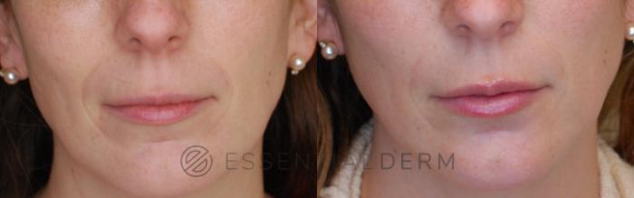 Before & After Dermal Fillers Case 20 Front View in Natick, Weston, Wayland, Framingham, and Wellesley, MA