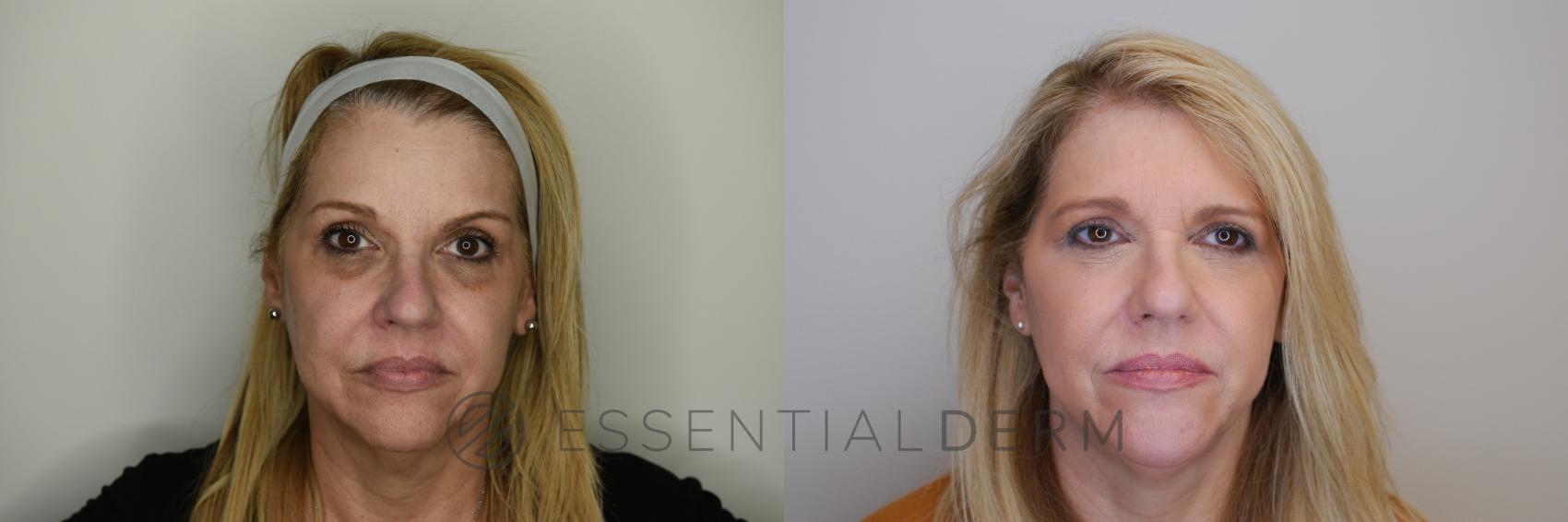 Before & After Dermal Fillers Case 22 Front View in Natick, Weston, Wayland, Framingham, and Wellesley, MA