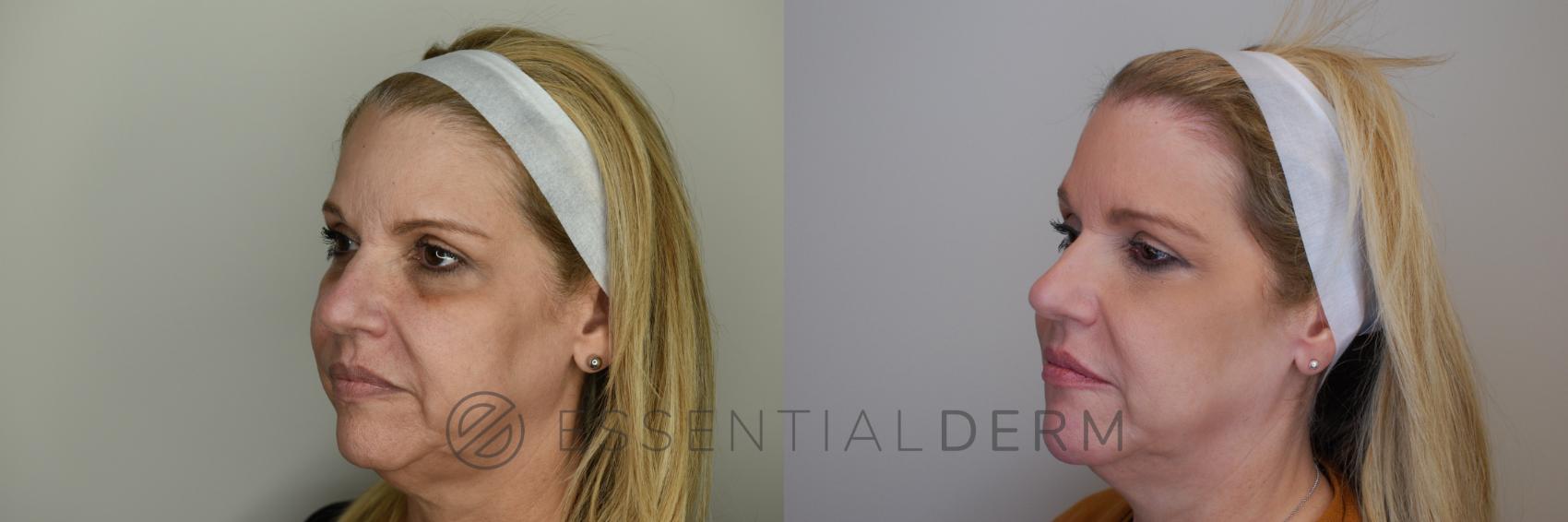 Dermal Fillers Case 22 Before & After Left Oblique | Natick, MA | Essential Dermatology