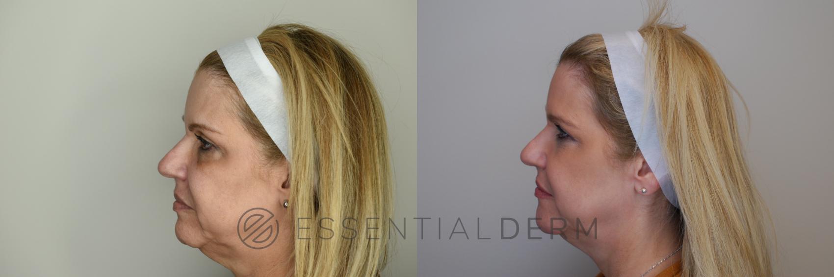 Dermal Fillers Case 22 Before & After Left Side | Natick, MA | Essential Dermatology