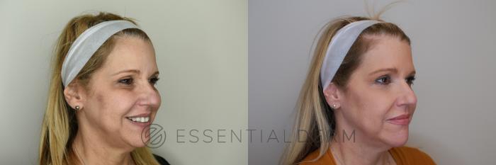 Before & After Dermal Fillers Case 22 Right Oblique View in Natick, Weston, Wayland, Framingham, and Wellesley, MA