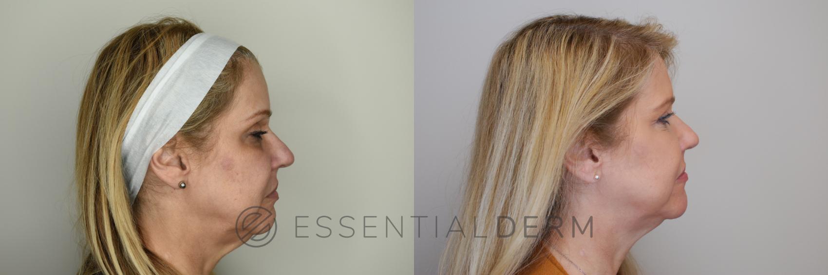 Dermal Fillers Case 22 Before & After Right Side | Natick, MA | Essential Dermatology