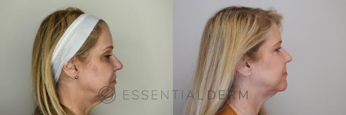 Before & After Dermal Fillers Case 22 Right Side View in Natick, Weston, Wayland, Framingham, and Wellesley, MA