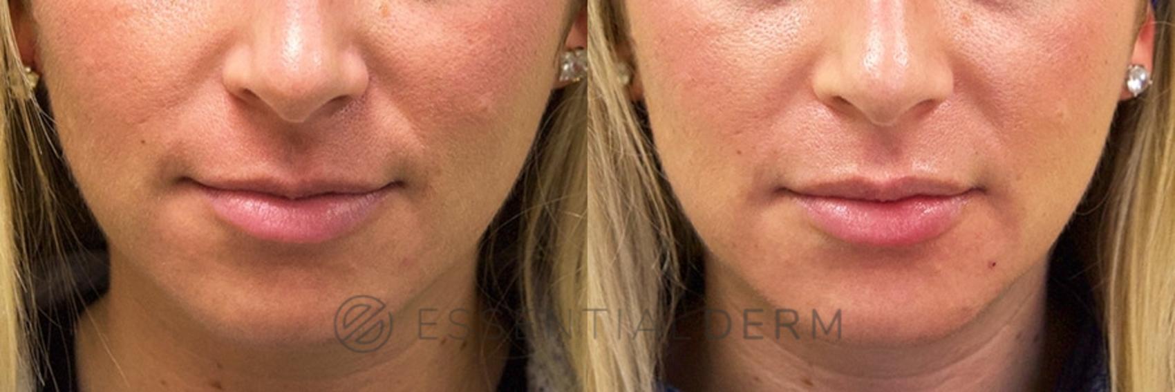 Before & After Dermal Fillers Case 8 Front View in Natick, Weston, Wayland, Framingham, and Wellesley, MA