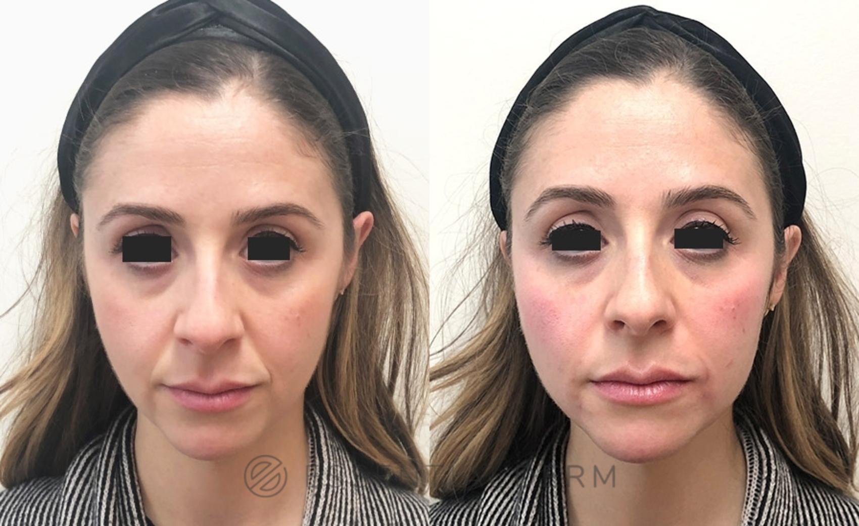 Before & After Dermal Fillers Case 9 Front View in Natick, Weston, Wayland, Framingham, and Wellesley, MA