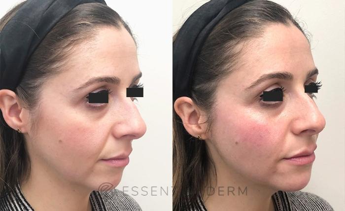 Before & After Dermal Fillers Case 9 Right Oblique View in Natick, Weston, Wayland, Framingham, and Wellesley, MA