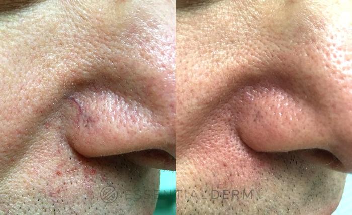 Before & After Intense Pulsed Light (IPL) Case 12 Right Side View in Natick, Weston, Wayland, Framingham, and Wellesley, MA