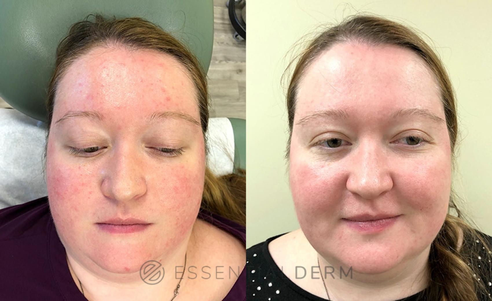 Ipl Light Therapy Before And After at Kristen Millett blog