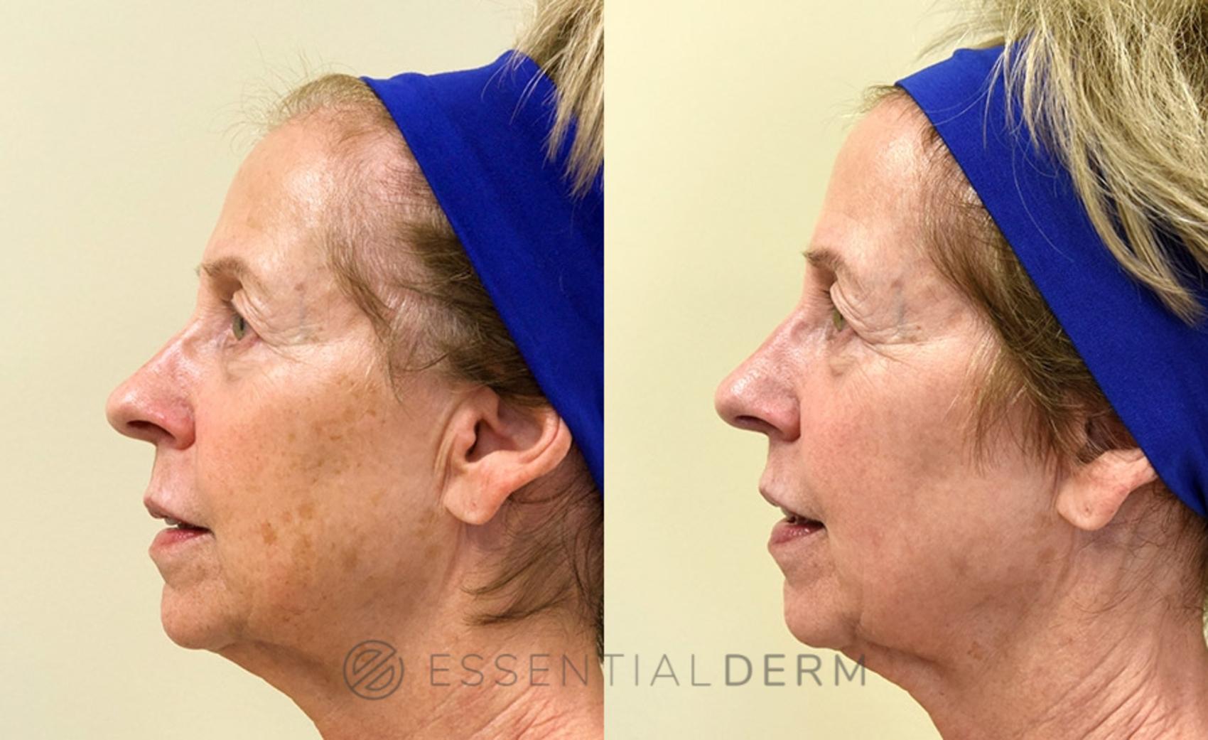 Before & After Intense Pulsed Light (IPL) Case 14 Left Side View in Natick, MA