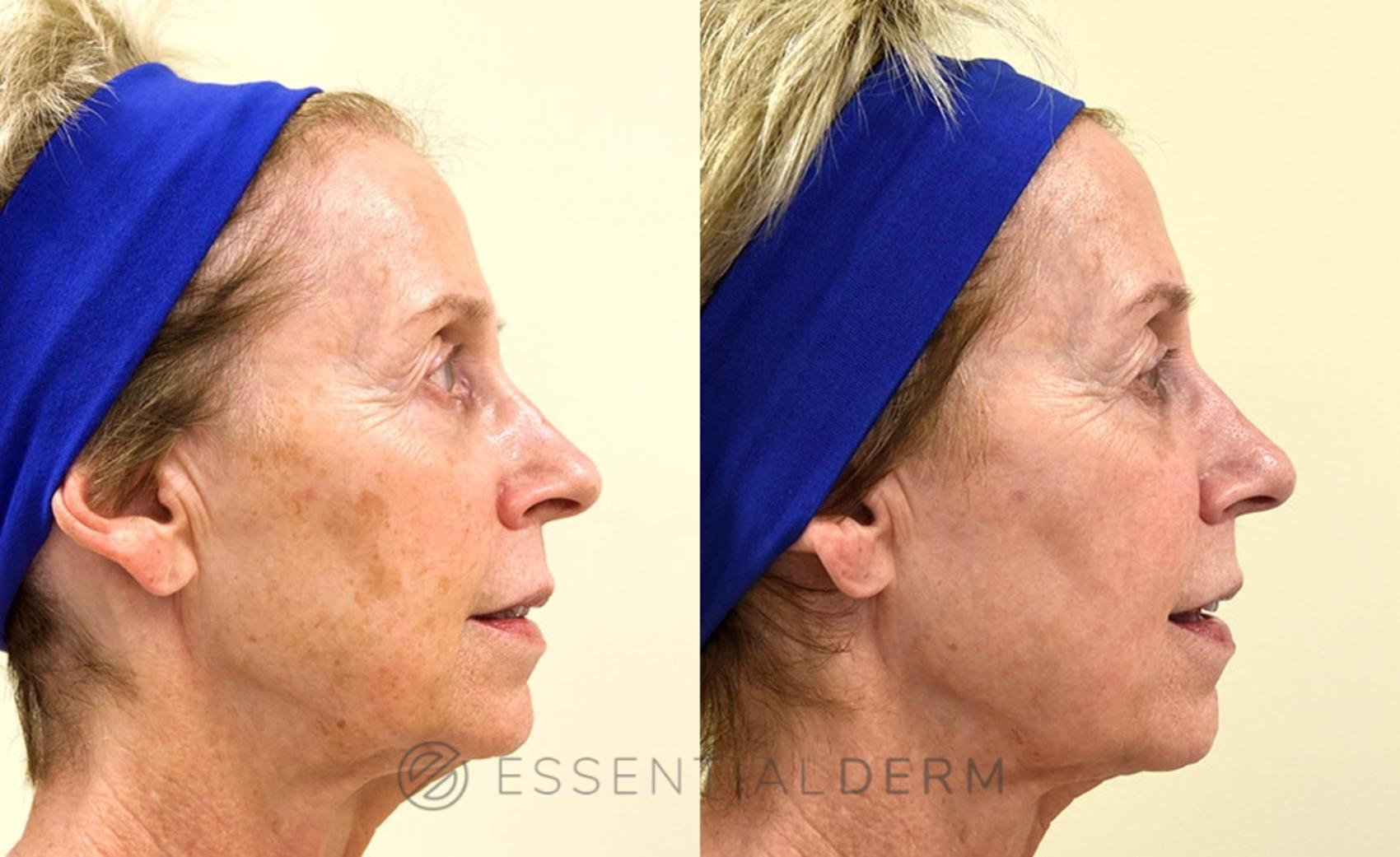 Before & After Intense Pulsed Light (IPL) Case 14 Right Side View in Natick, MA