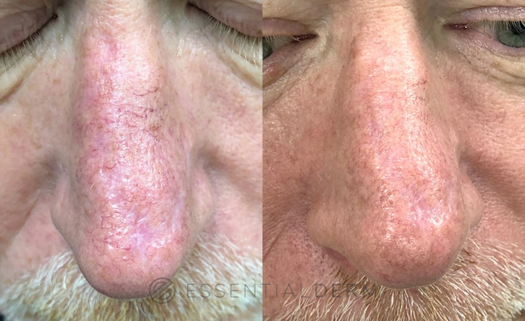 Before & After Intense Pulsed Light (IPL) Case 15 Front View in Natick, MA