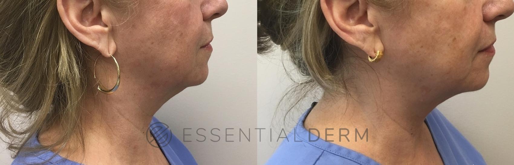 Before & After KYBELLA® Case 37 Right Side View in Natick, Weston, Wayland, Framingham, and Wellesley, MA