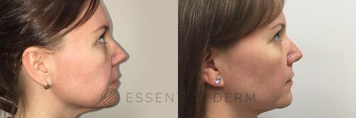 Before & After KYBELLA® Case 6 Right Side View in Natick, Weston, Wayland, Framingham, and Wellesley, MA