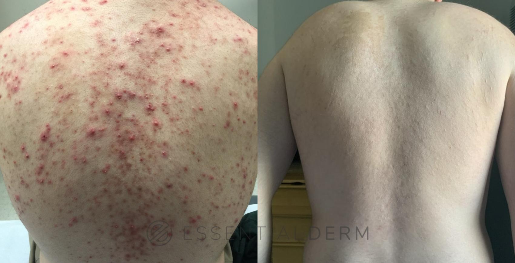 Before & After Medical Before and after photos  Case 17 Back View in Natick, MA