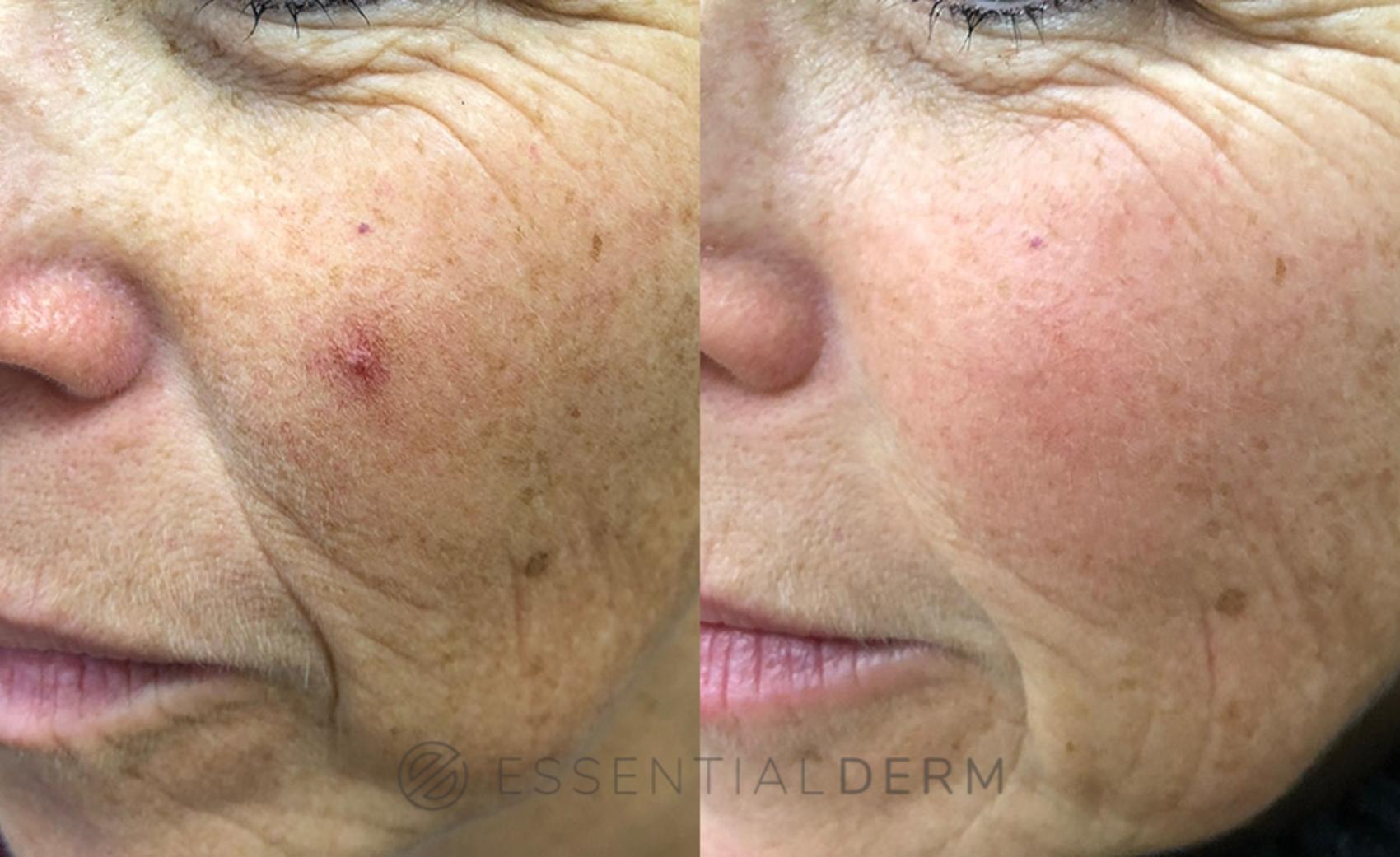 Before & After Pulsed Dye Laser Case 11 Left Oblique View in Natick, MA