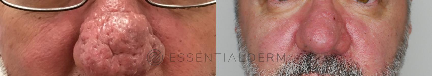Rhinophyma Case 21 Before & After Front | Natick, MA | Essential Dermatology