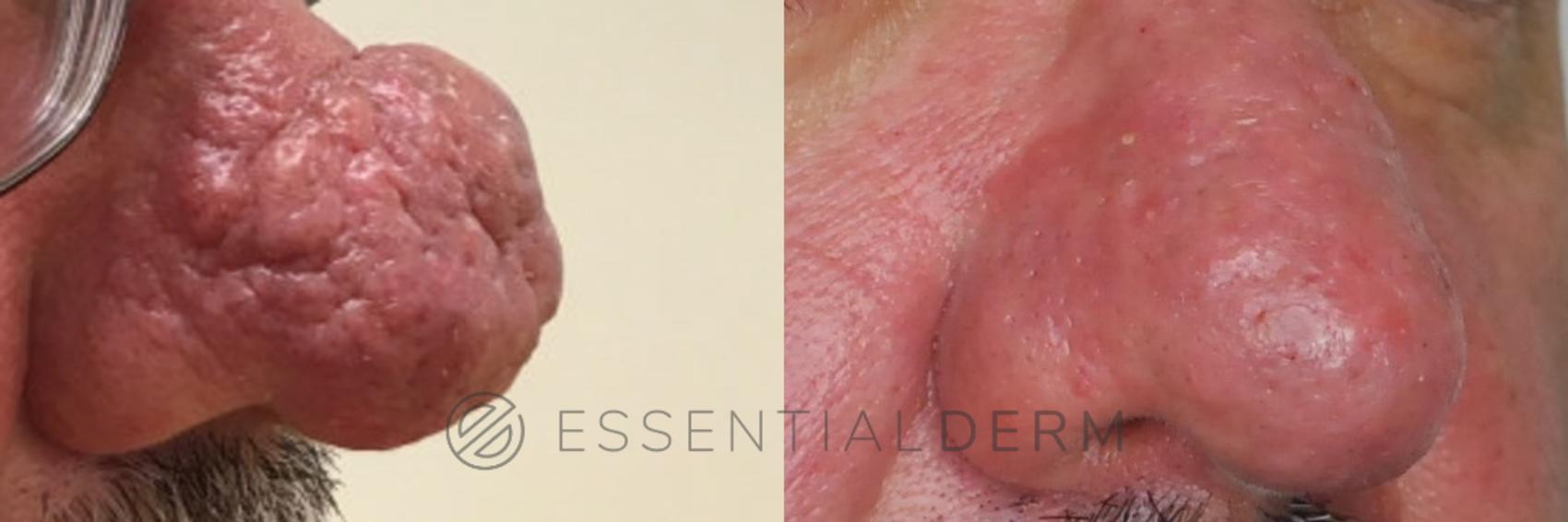 Rhinophyma Case 21 Before & After Right Side | Natick, MA | Essential Dermatology