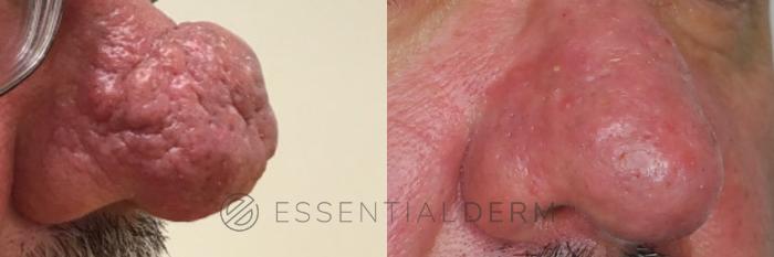 Before & After Rhinophyma Case 21 Right Side View in Natick, Weston, Wayland, Framingham, and Wellesley, MA