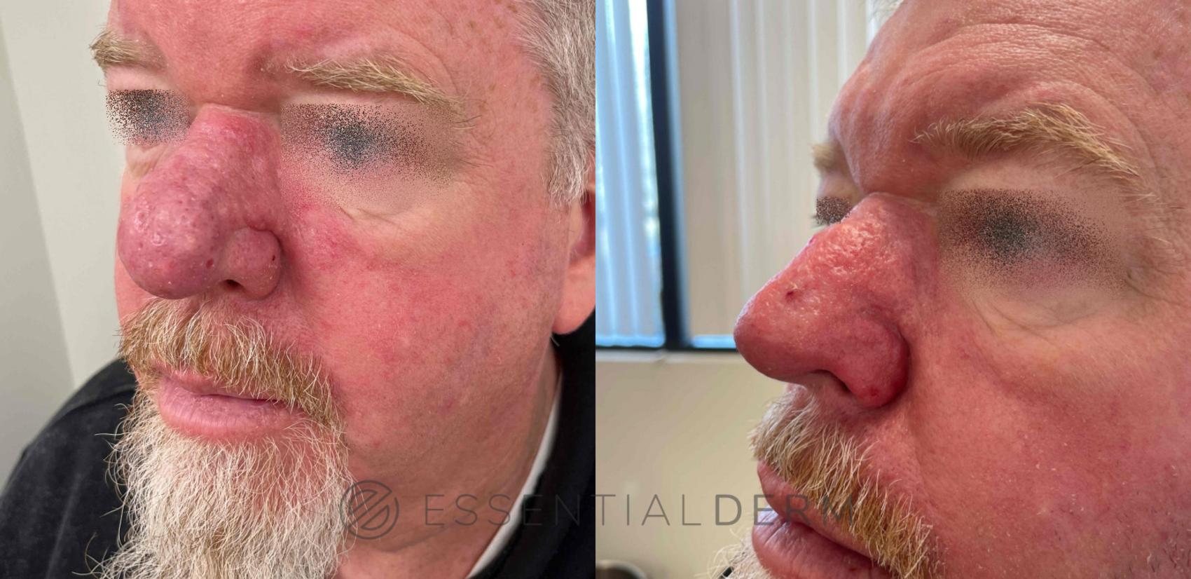 Before & After Rhinophyma Case 32 Left Side View in Natick, Weston, Wayland, Framingham, and Wellesley, MA