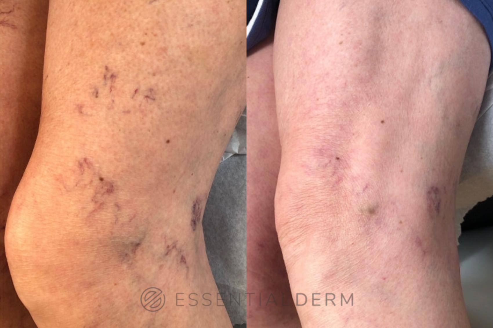 Before & After Sclerotherapy Case 29 Left Side View in Natick, Weston, Wayland, Framingham, and Wellesley, MA