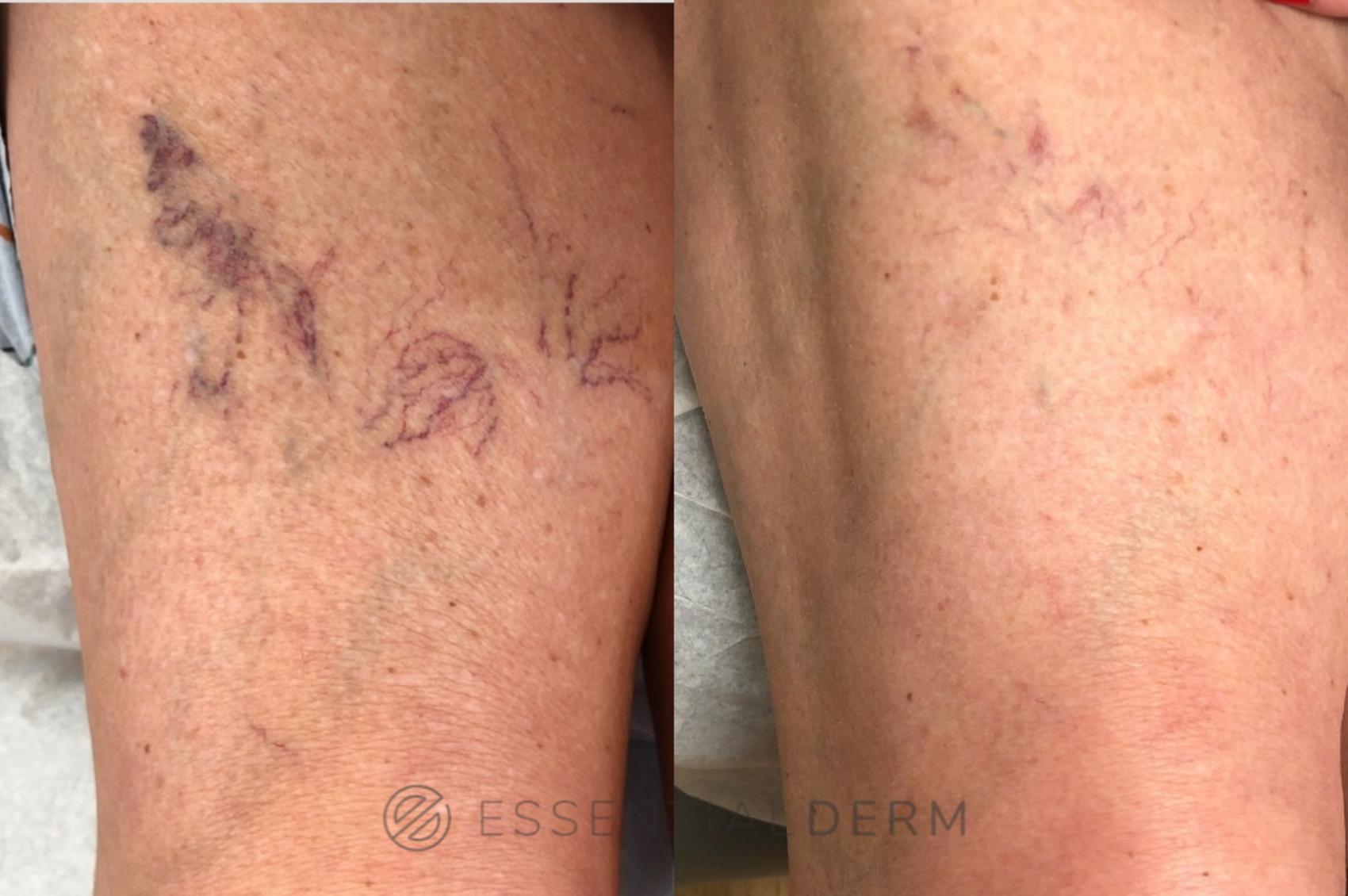 Before & After Sclerotherapy Case 29 Right Side View in Natick, MA