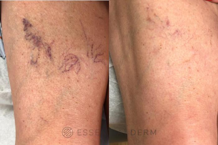 Before & After Sclerotherapy Case 29 Right Side View in Natick, Weston, Wayland, Framingham, and Wellesley, MA
