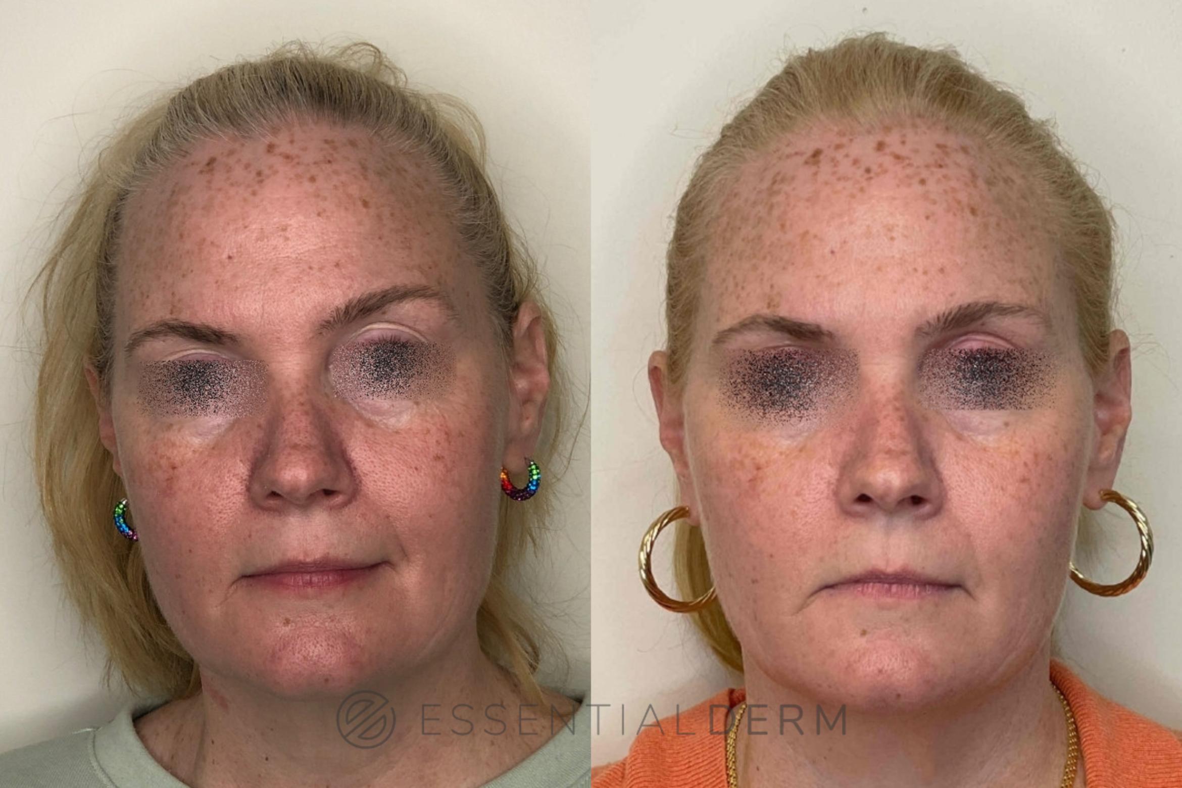Before & After SCULPTRA® Case 30 Front View in Natick, MA